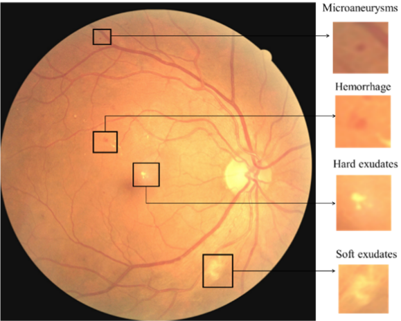 Retinal disorder